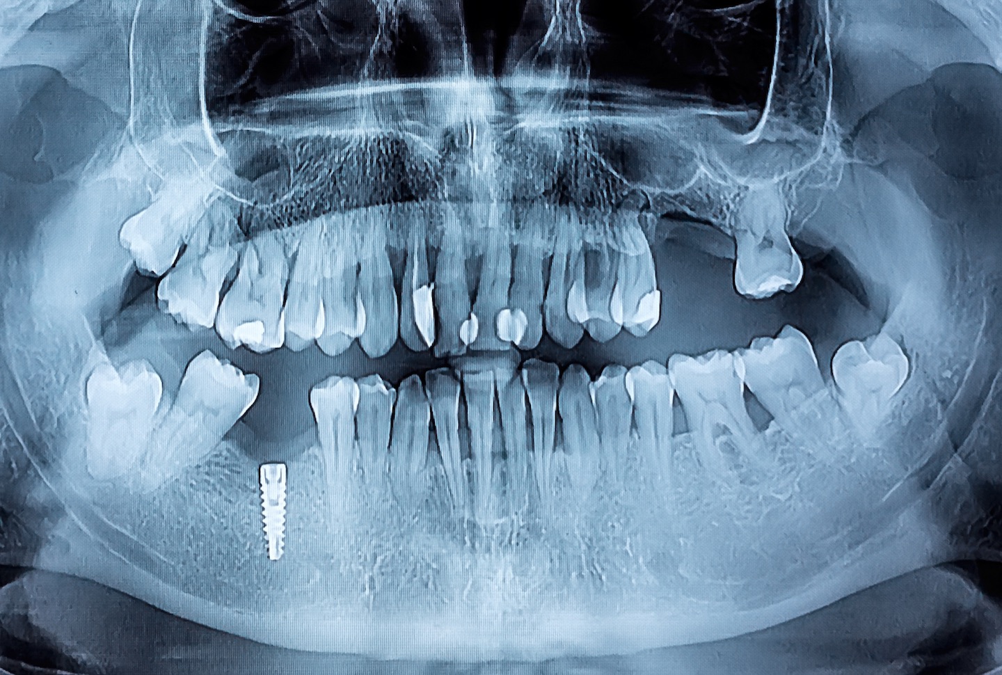 Full Mouth Rehabilitation